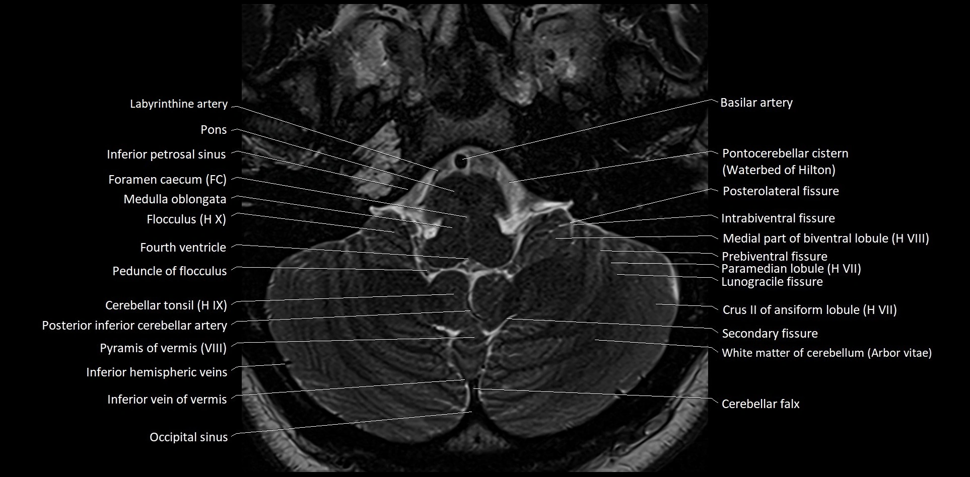 MRI Cerebellar anatomy High-resolution labelled 3T MRI image 9.webp